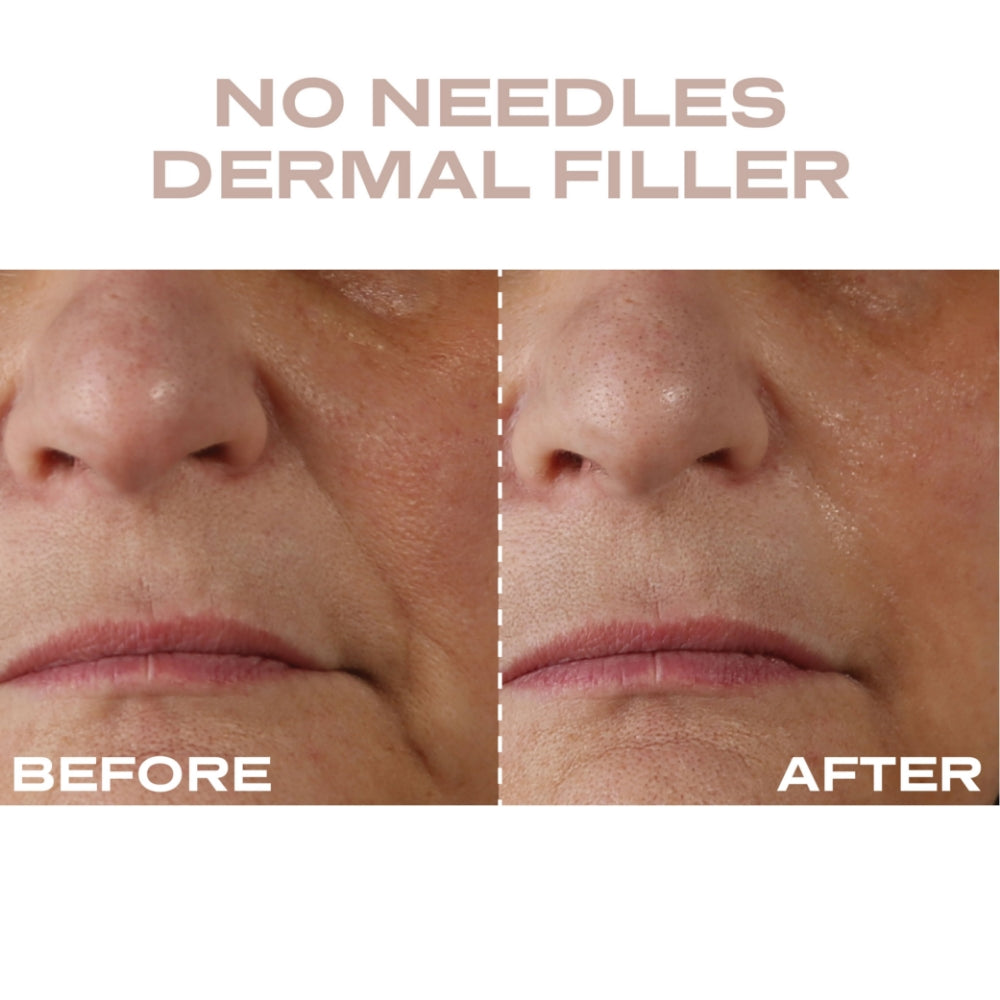 PLUM0008-4.jpg Plump It No Needles Derma Filler Pods Starter Kit 15 x 10ml - Image 1