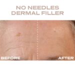 Plump It No Needles Derma Filler Pods Starter Kit 15 x 10ml - Image 3